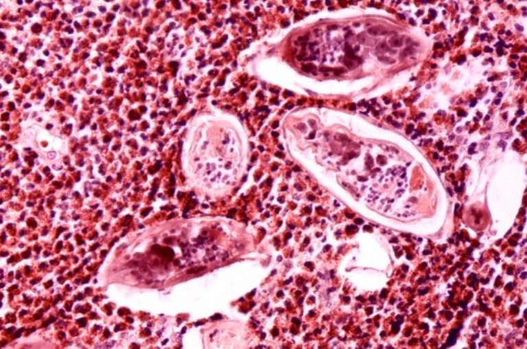 Шистосомози